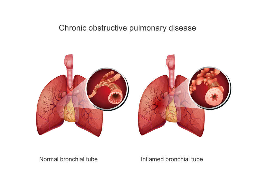 Chronic obstructive pulmonary disease