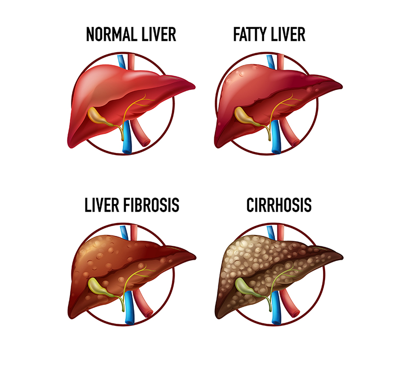 Liver disease Alpha-1 Antitrypsin deficiency