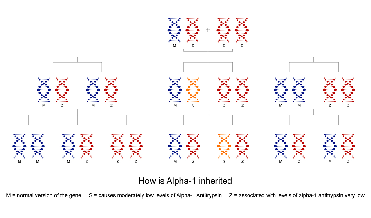 Mutation Alpha-1 Antitrypsin Deficiensy