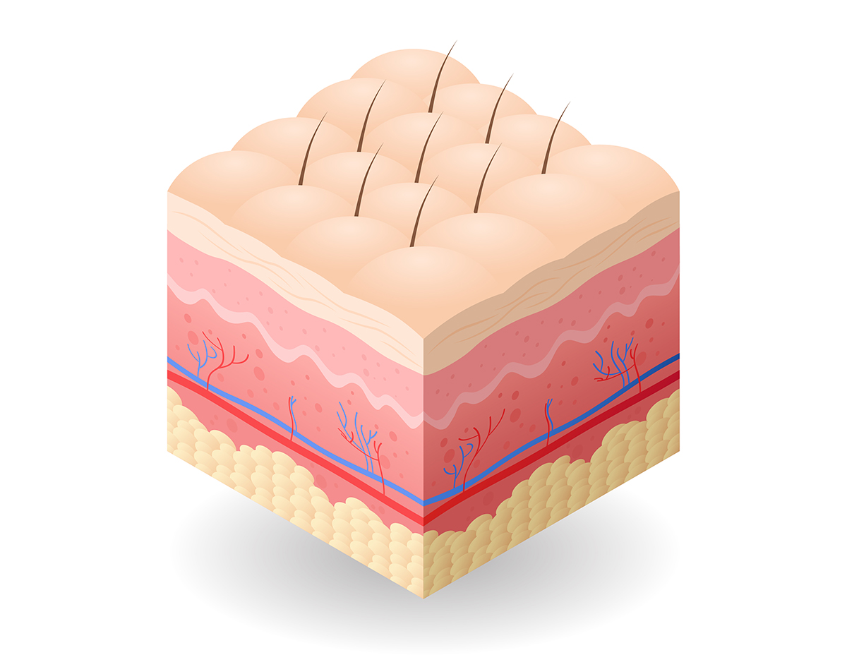 skin Panniculitis - Alpha-1 Antitrypsin Deficiency